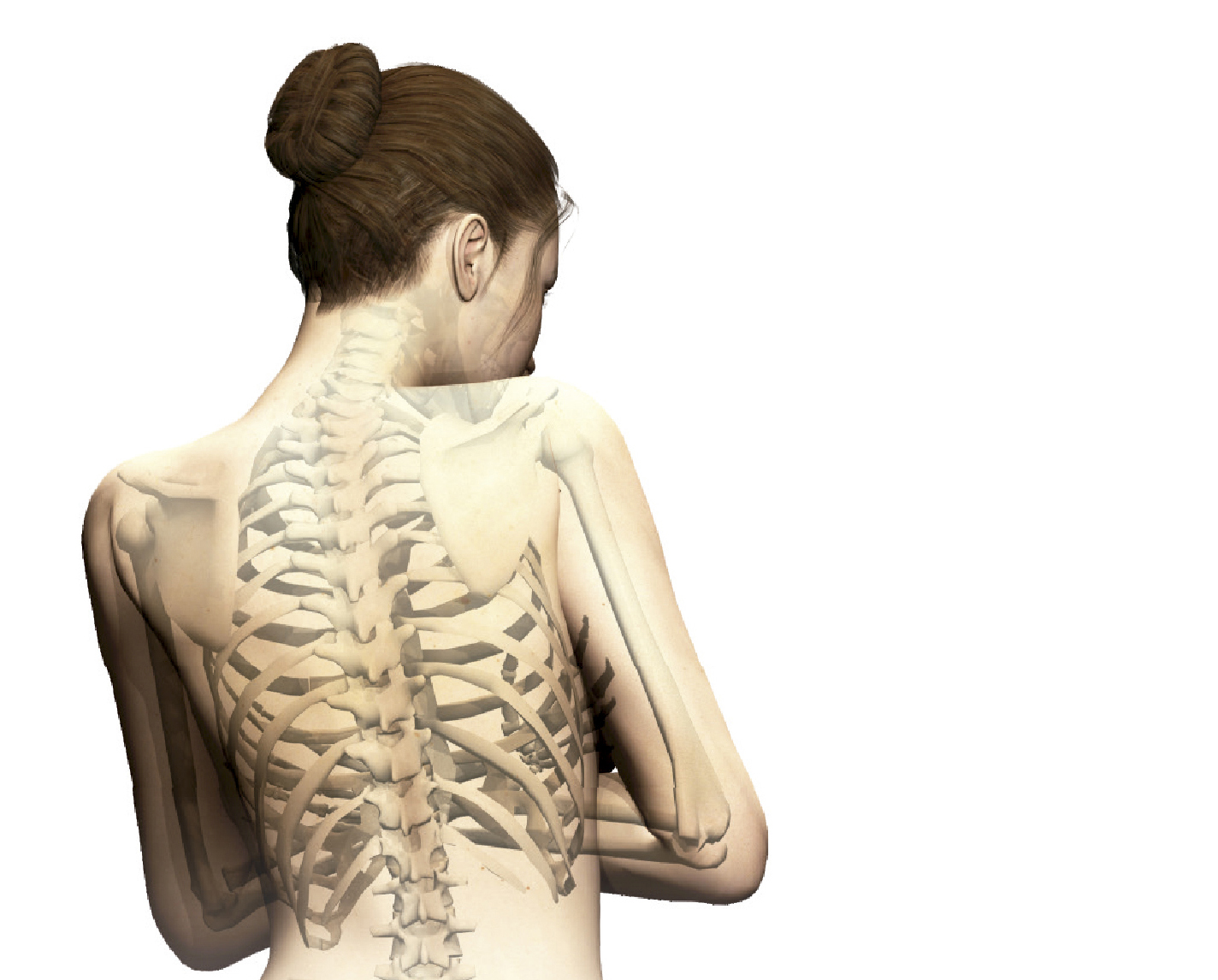 osteoporosis